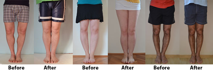 Bow Legs No More Before And After